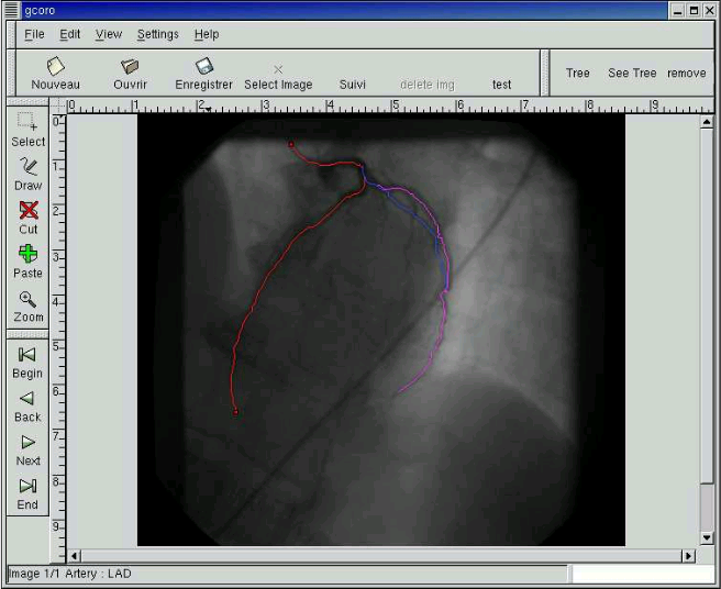 Identifying arteries in an other pictures allowing the 3D reconstruction Identifying arteries in an other pictures toto allow the 3D reconstruction